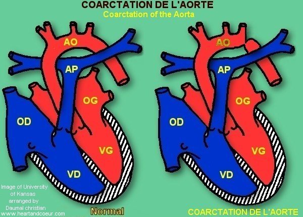 Coarctation de l'aorte - Coarctation of the Aorta