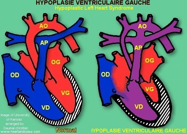 Hypoplasie ventriculaire gauche - Hypoplastic left Heart Syndrome - HLHS