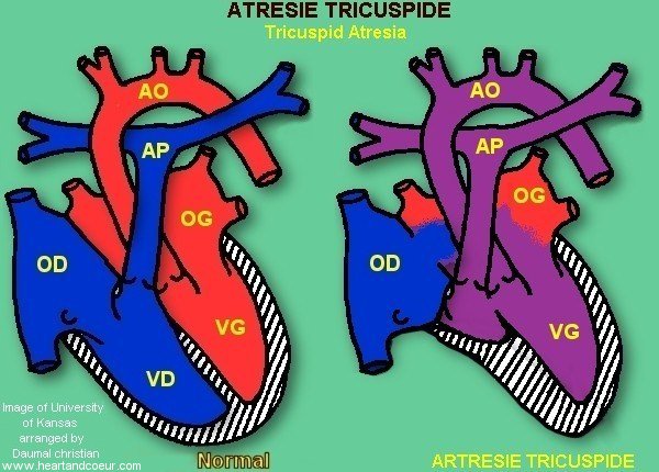atresie tricuspide - Tricuspid atresia 