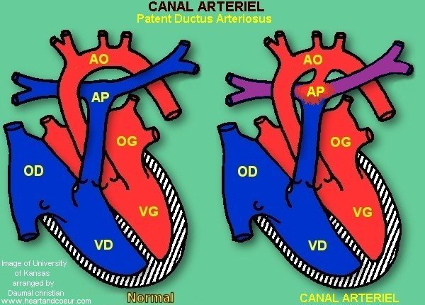 canal arteriel  - Patent Ductus Arteriosus