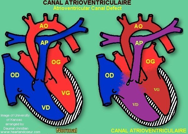Atrioventricular Canal Defect - Canal atrioventriculaire