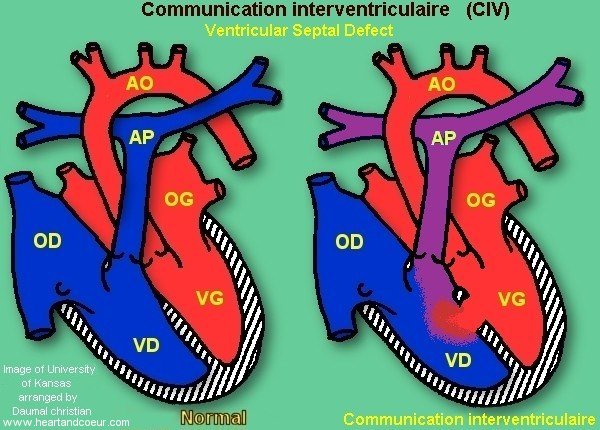 Communication intraventriculaire,CIV,Ventricular Septal Defect,VSD