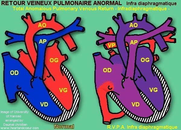 Retour Veineux pulmonaire infradiaphragmatique - Total Anomalous Pulmonary Venous Return infradiaphragmatic
