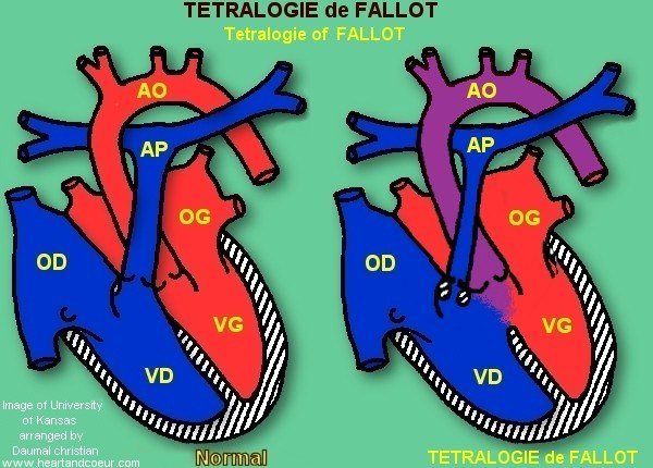 Tétralogie de Fallot - Tetralogie of Fallot