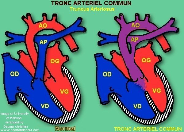 Tronc Artériel Commun - Truncus Arteriosus