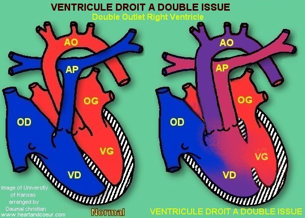 Ventricule droit double issue - VDDI -  Double Outlet Right Ventricle - DORV