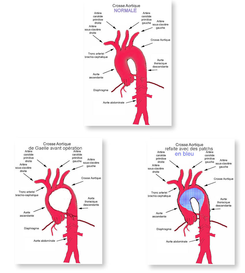 Crosse aortique de Gaelle